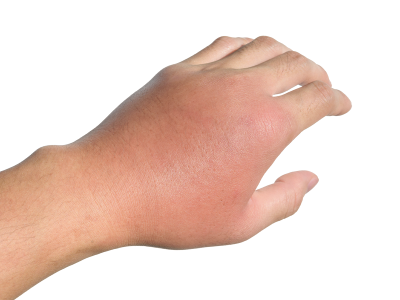 Cellulitis- what is it?